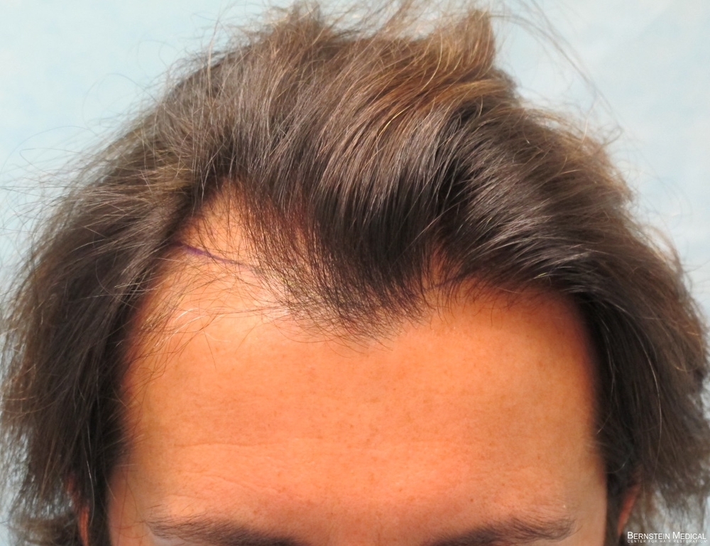 Norwood Class 3 Fut Hair Transplant Before And After Photos