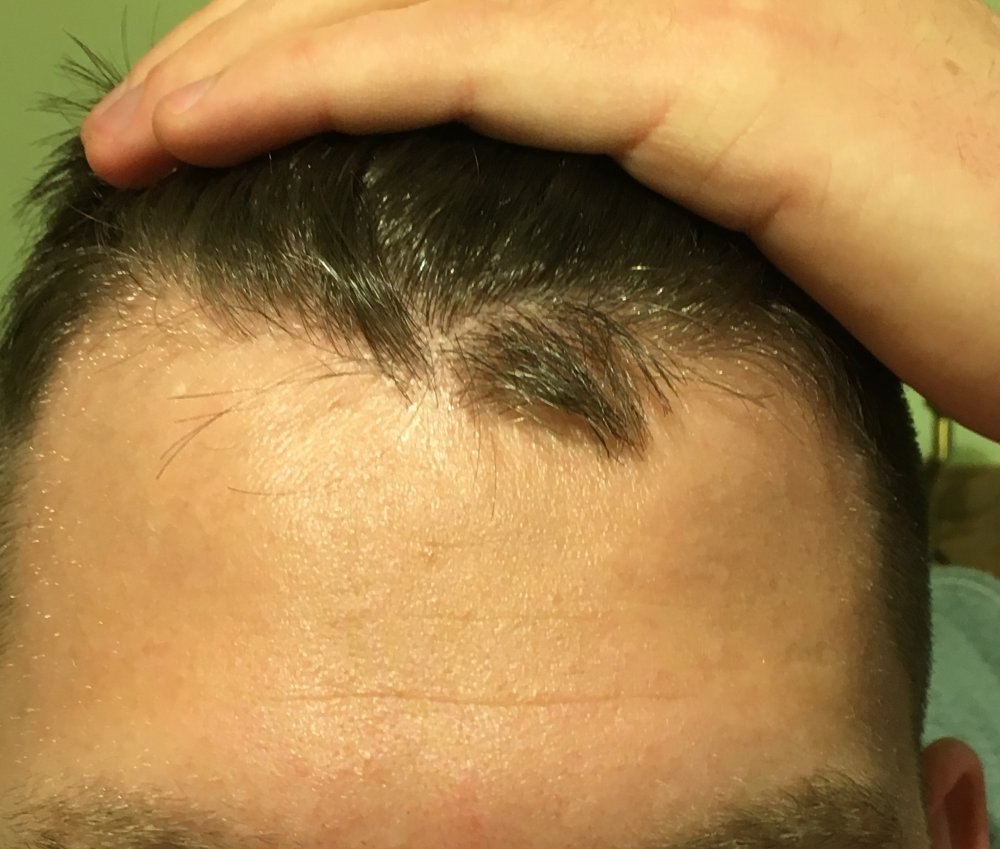 11 hairline.jpg