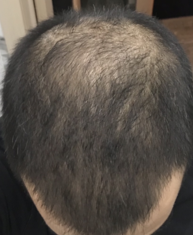 is minoxidil a waste of time