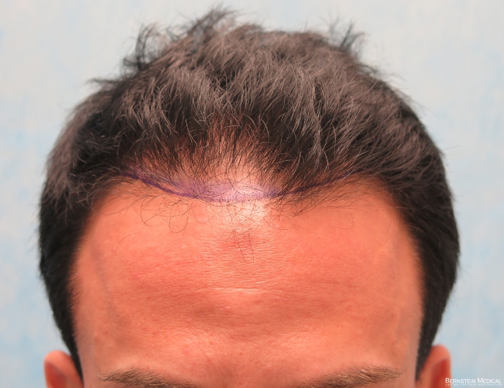 1b-position-of-planned-hairline-ctc.jpg