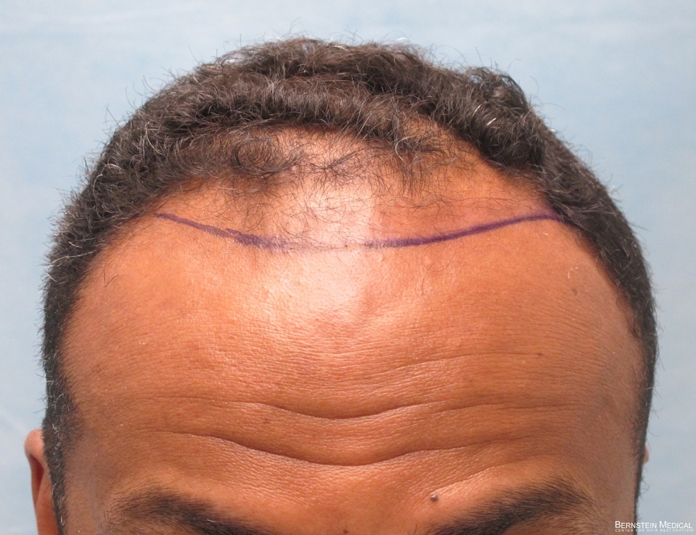 1b_position-of-planned-hairline_ijc.jpg