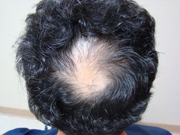 2-male-pattern-baldness-before.jpg