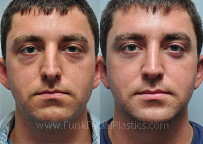 %201%20Frontal%20Male%20Rhinoplasty,%20Lower%20Blepharoplasty%20and%20Otoplasty%20b&a%201%20year.jpg