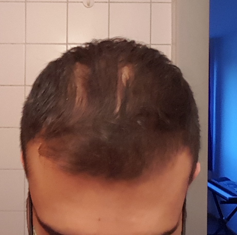 Started Dutasteride Second Time How Much Regrowth Can I Expect