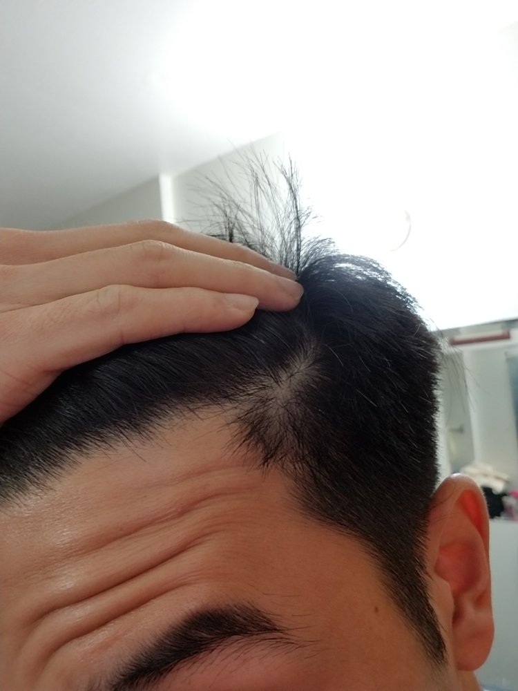 Can T Tell How If Thinning Receding Or Both Hairlosstalk Forums
