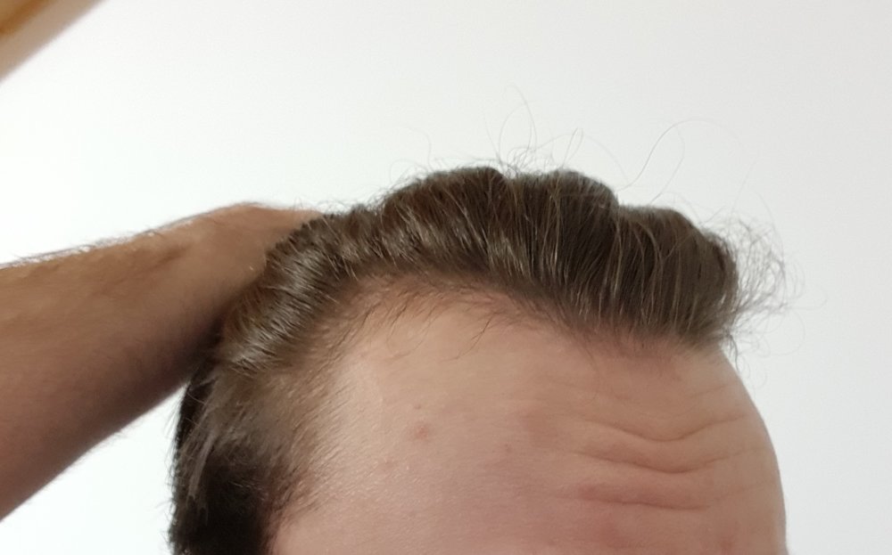 old hairline