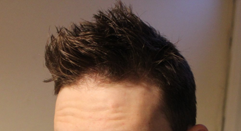 Thinning Hairline At The Tip What Should I Expect Hairlosstalk Forums