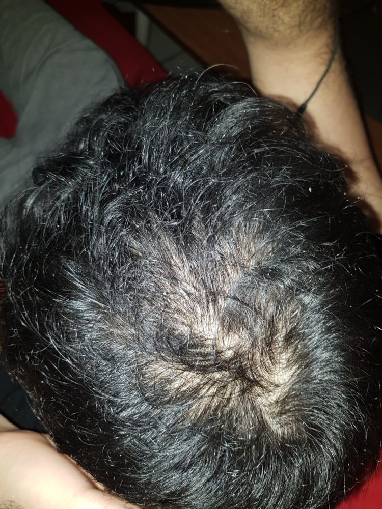 my proscar + minoxidil results after almost a year of