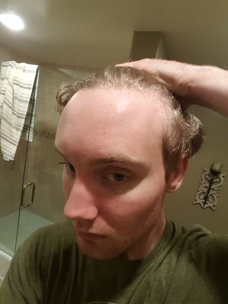 Please Let Me Know If My Crown Is Thinning. 20 Years Old