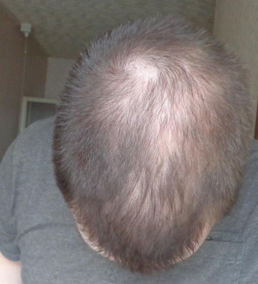 Pretty Great Results Just Adding Nizoral HairLossTalk Forums