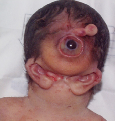 228px-Otocephaly_and_cyclopia.png