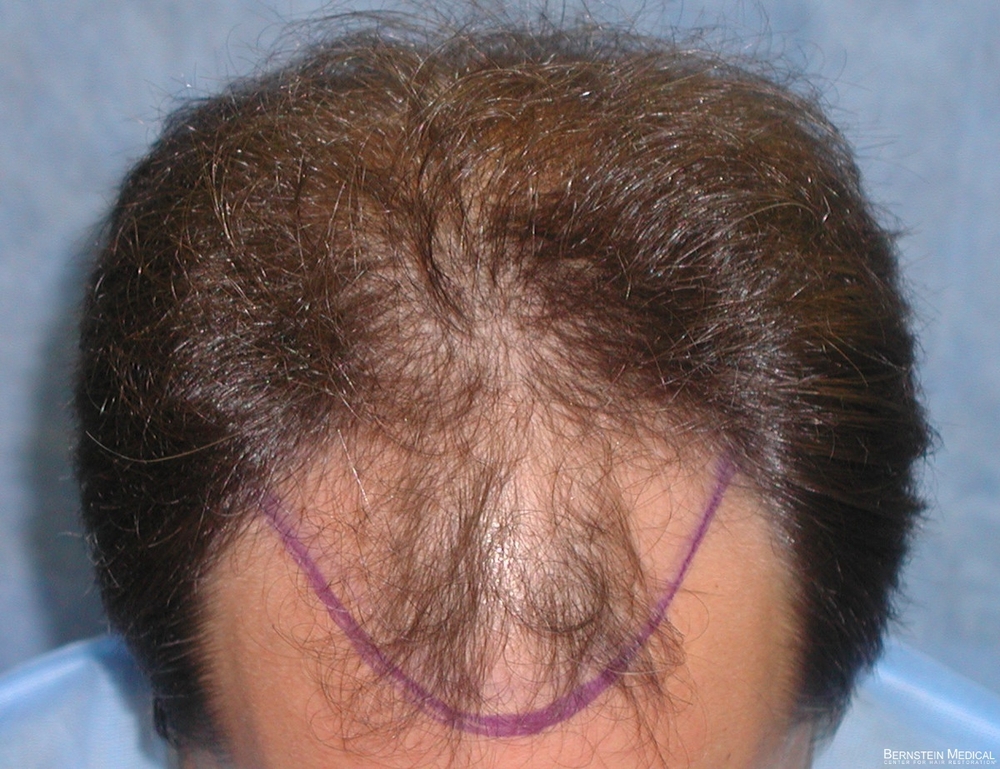 2b_position-of-hairline-top-view_hyc.jpg