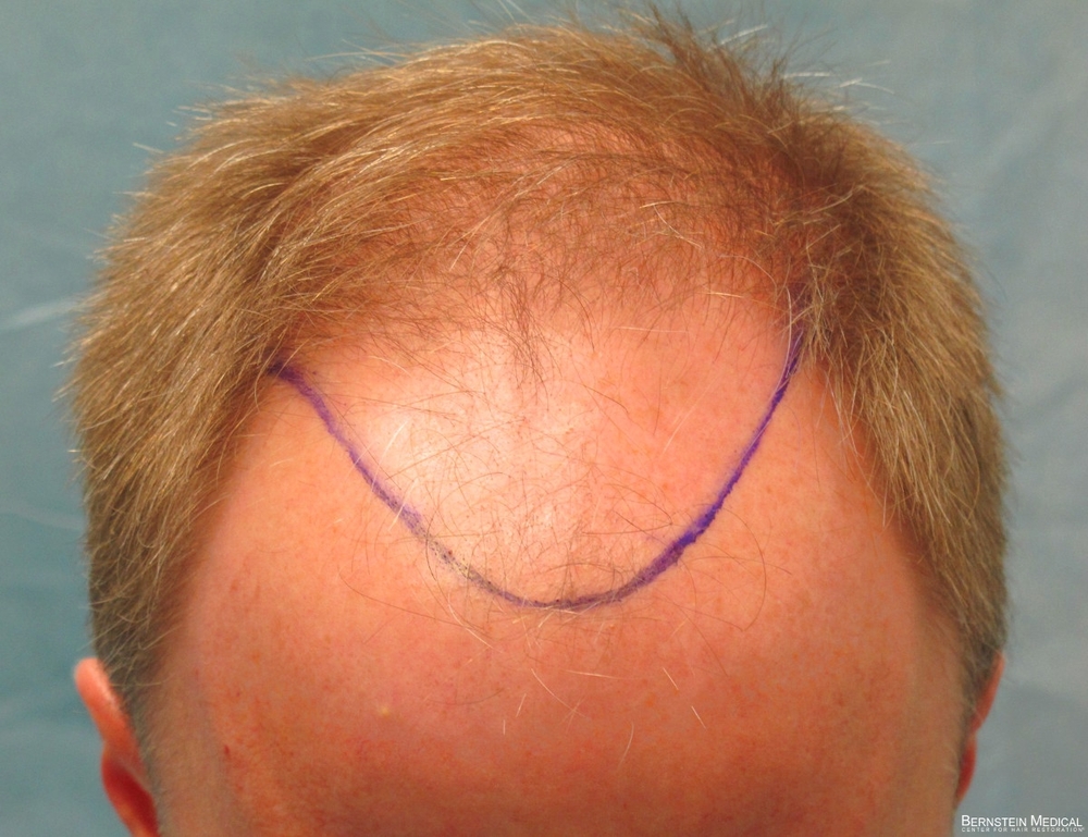 2b_position-of-hairline-top-view_rfr.jpg