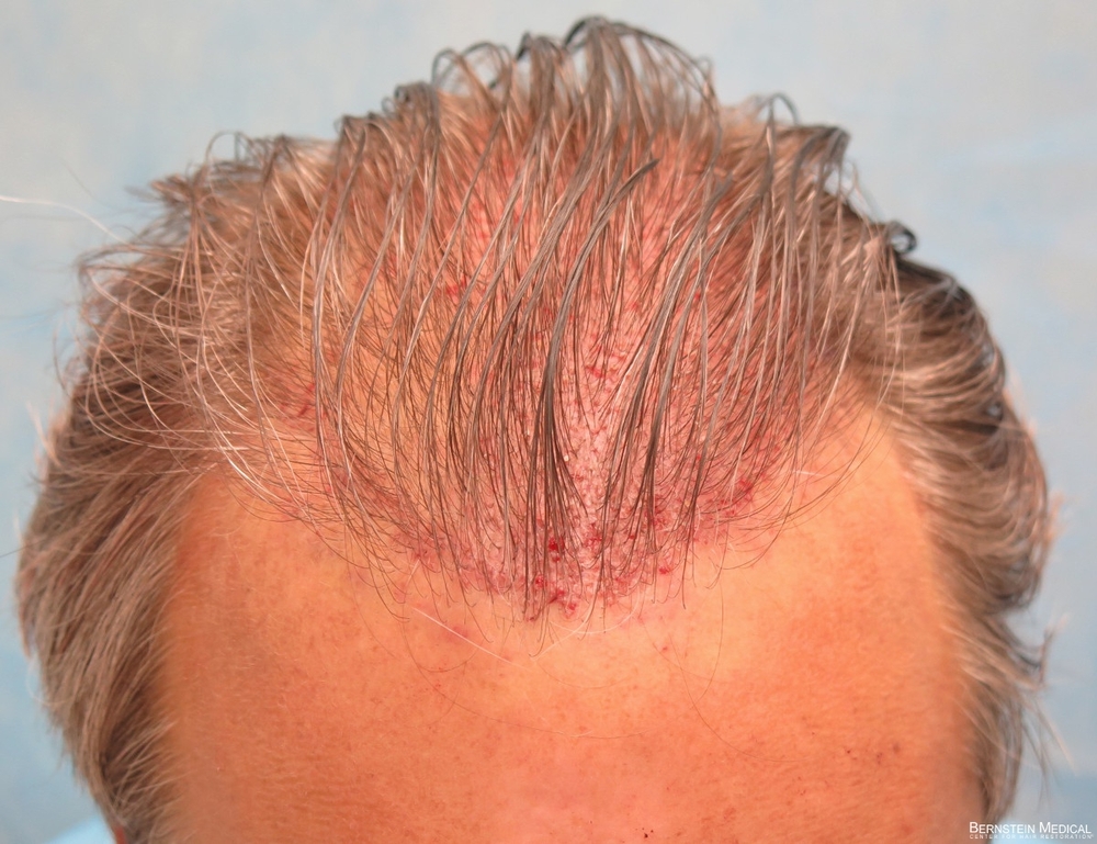 2c_placement-of-grafts-3rd-session_hyc.jpg