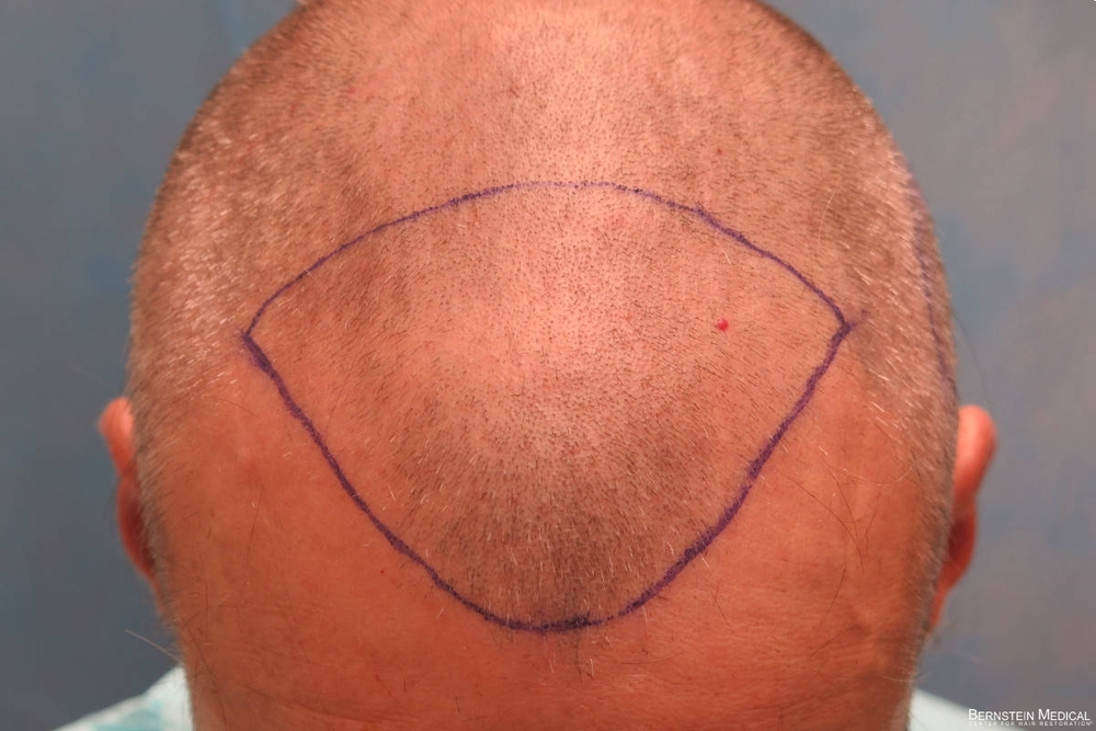 2c_shaved-head_top-view_lki-1s.jpg