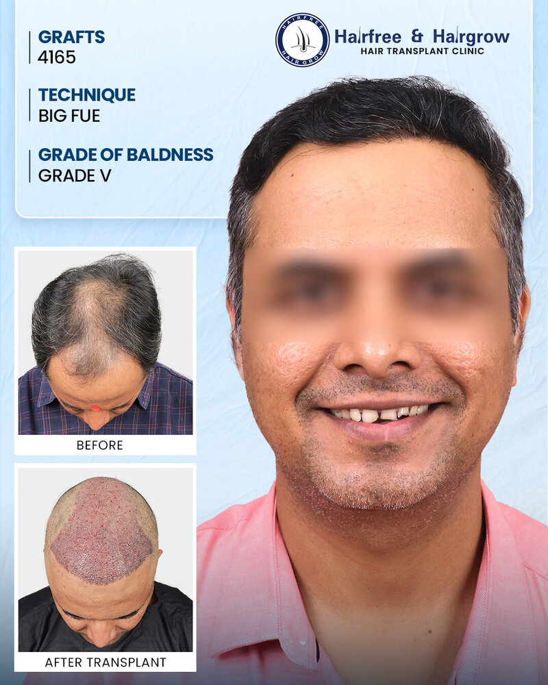 4165-grafts-big-fue-hair-transplant-grade-5-pune (1).jpg