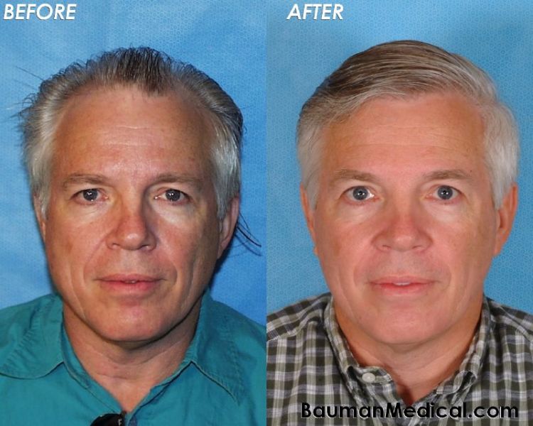 50-year-old-male-hair-transplant-Doctor-Bauman-Medical-Patient-Before-After-750x600.jpg