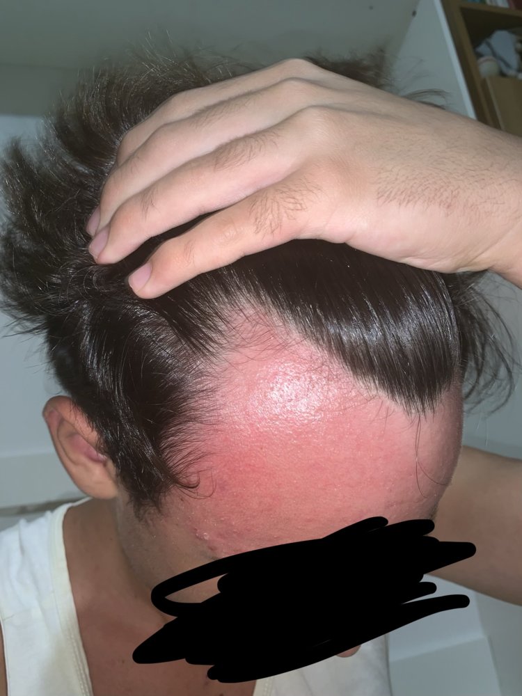 Receding Hairline At 15 Please Help Me HairLossTalk Forums