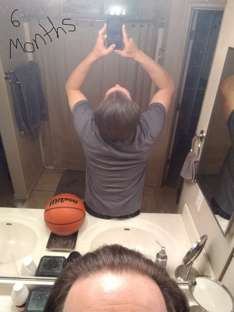 6 months finasteride.jpg
