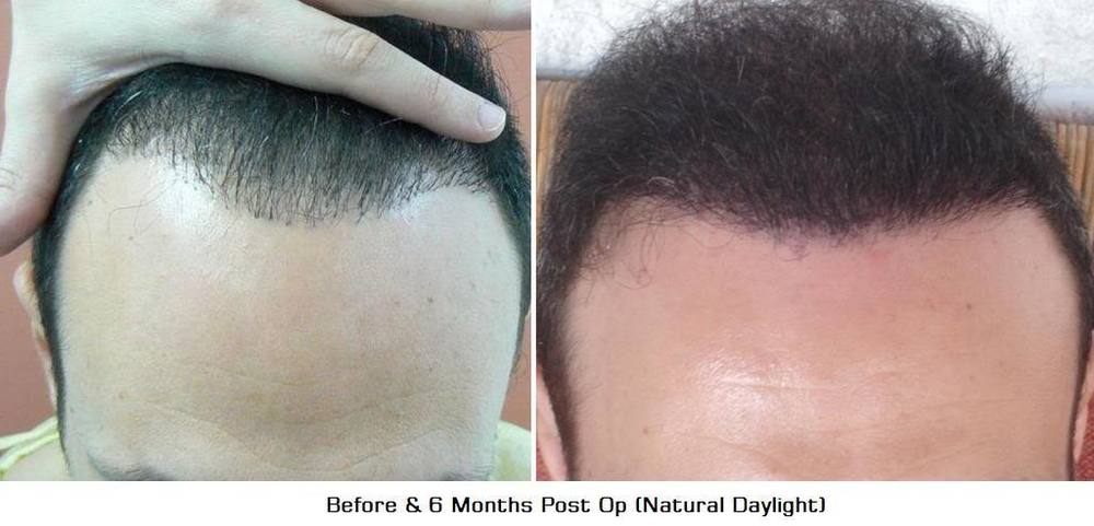 7Before6MonthsPostOpFrontal.jpg