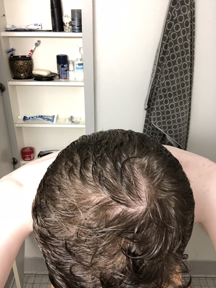 Is This Diffuse Thinning How Bad Is It Advice Needed