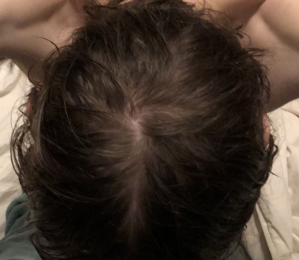 24 Year Old Male Model Am I Balding? | HairLossTalk Forums