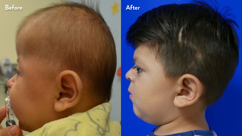 -after-craniosynostosis-stanford-childrens-800x450.jpg
