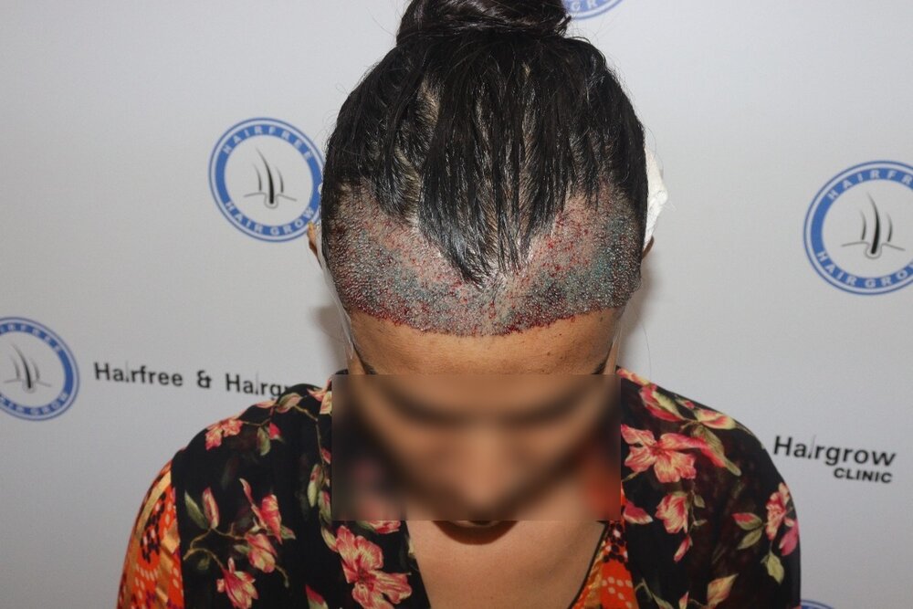 after transplant (1).JPG