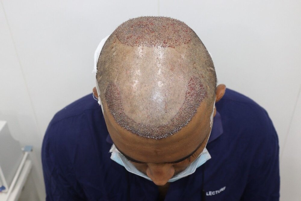 after transplant.JPG