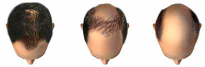 alopecia-androgenetica.jpg