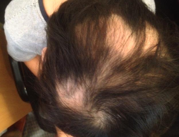 Alopecia-areata_James-Choi.jpg