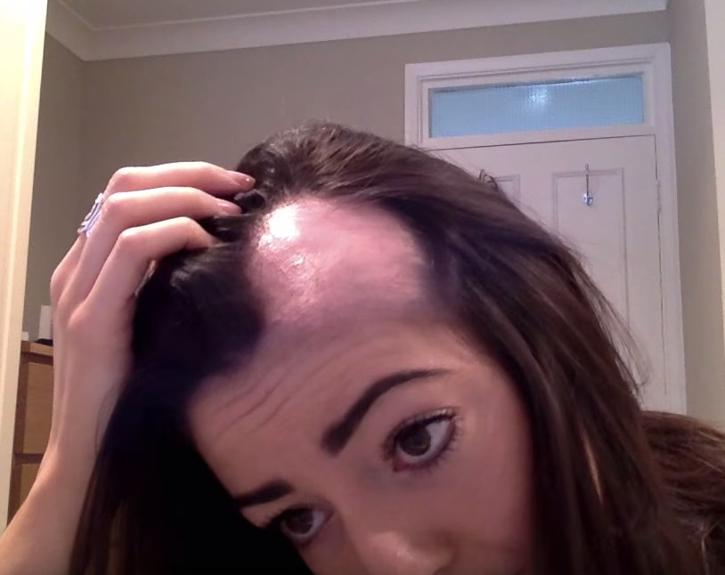 Alopecia_femenina.jpg