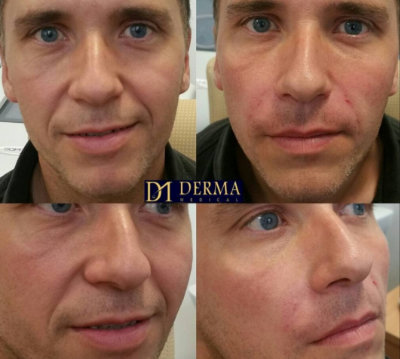 before-and-after-nasolabial-filler.jpg