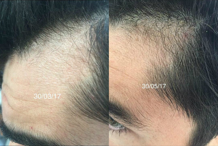 Brotzu-Lotion-Two-Month-Results.jpg