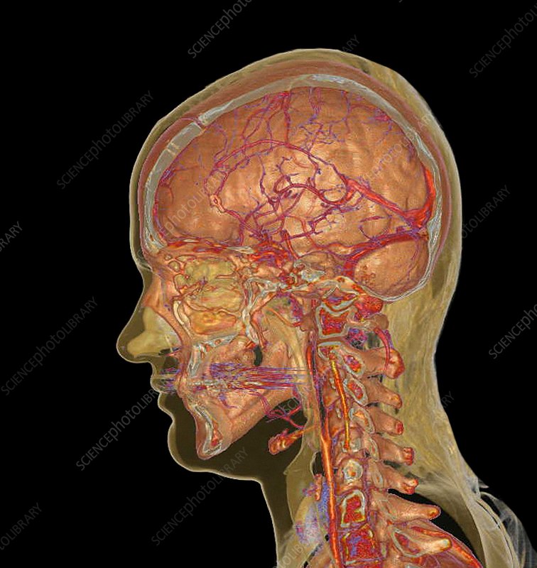 C0256850-Brain,_spine_and_blood_vessels,_CT_scan.jpg