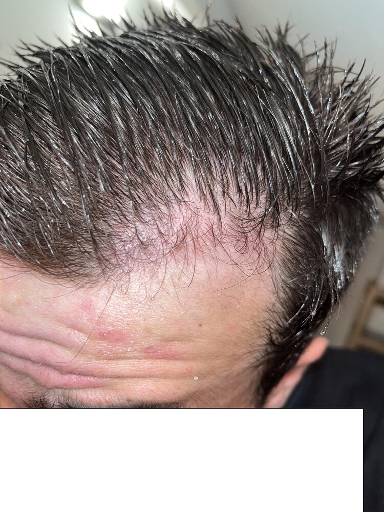 Calvitie_25_09.jpg