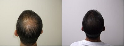 CBD-Oil-Before-After-Hair-Growth.jpg
