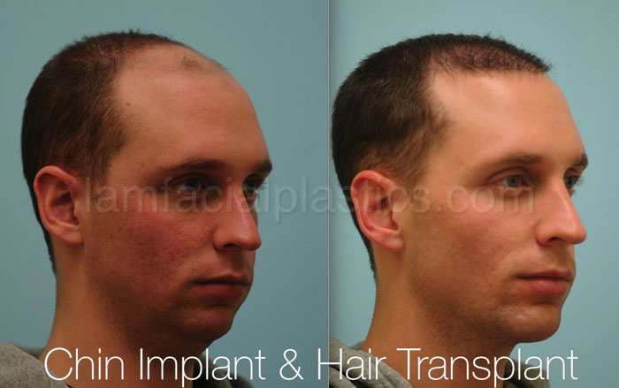 chin-augmentation-bxa-19.jpg