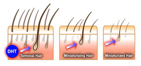DHT-Hair-Loss-Stages.png