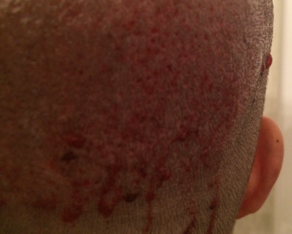 Donor TP 1 day 1.png