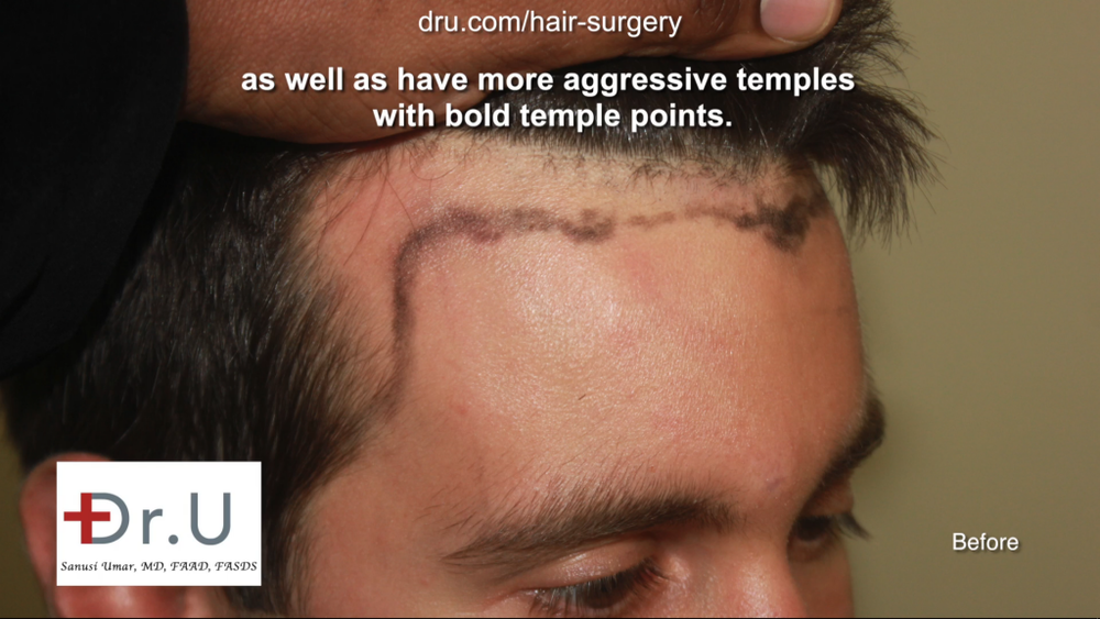 Dr._U_Uses_3200_Advanced_FUE_UGrafts_to_Create_Hairline_3-1024x576.png