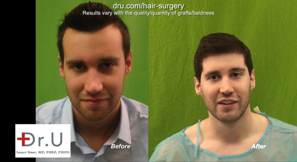 Dr._U_Uses_3200_Advanced_FUE_UGrafts_to_Create_Hairline_5-1024x561.png