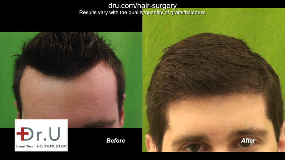 Dr._U_Uses_3200_Advanced_FUE_UGrafts_to_Create_Hairline_6-1024x576.png