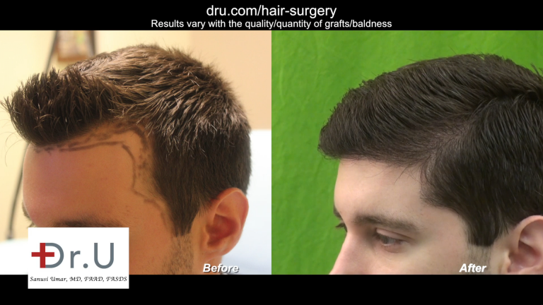 Dr._U_Uses_3200_Advanced_FUE_UGrafts_to_Create_Hairline_7-768x432.png