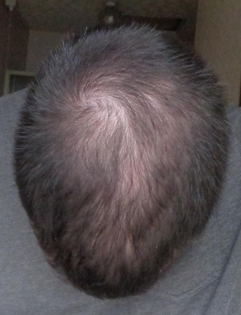 Pretty Great Results Just Adding Nizoral HairLossTalk Forums