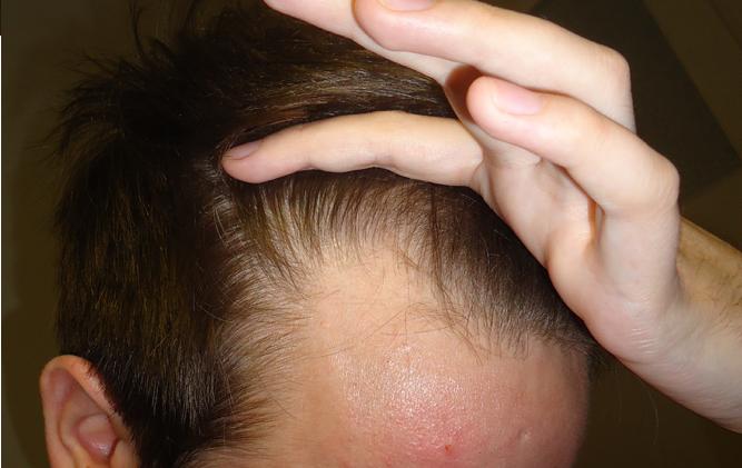 shedding starts finasteride phase