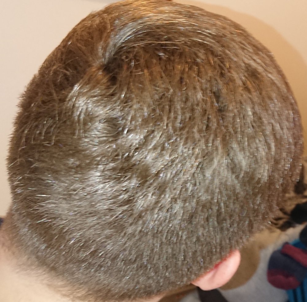 Very Early Stages Of A Thinning Crown? | HairLossTalk Forums