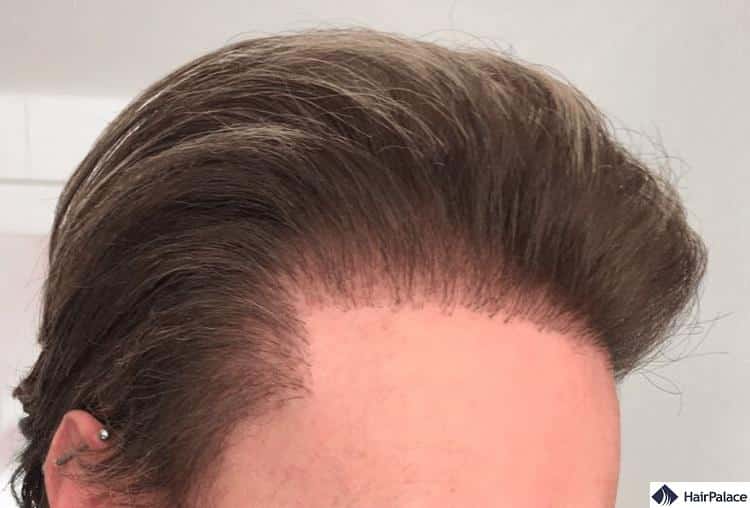 failed-celebrity-hair-transplant.jpg