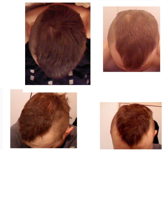 finasteride 1mg results reddit