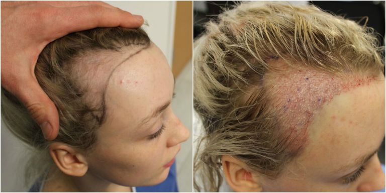 gallery-1474563222-diva-hollands-hair-transplant-traction-alopecia-transplant-side-by-side.jpg